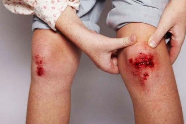Hemophilia
