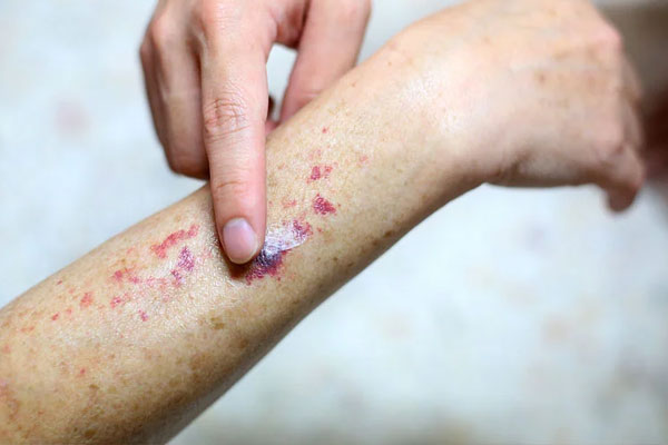 Leukemia